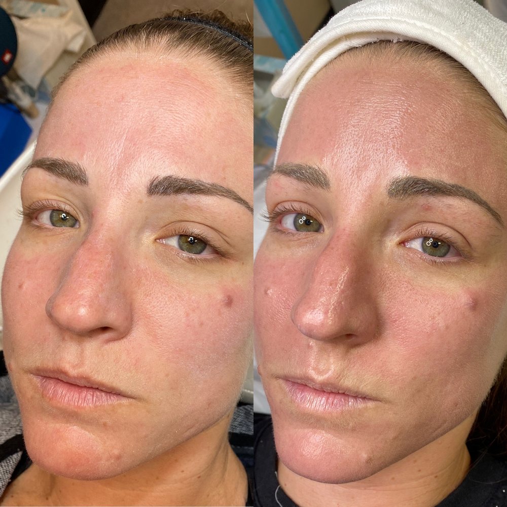 Bb glow facial treatment at candibrows for radiant, even-toned skin