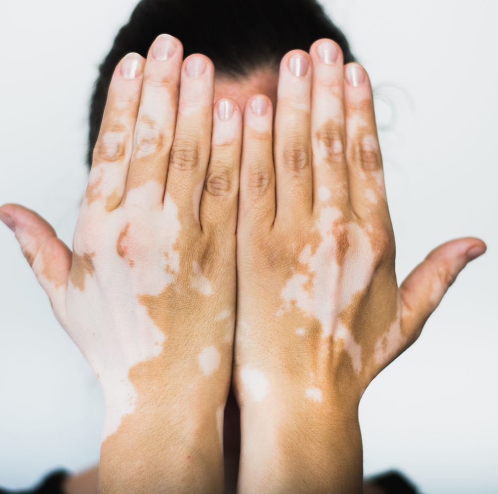 Scar and skin camouflage treatment at candibrows for smooth, natural coverage