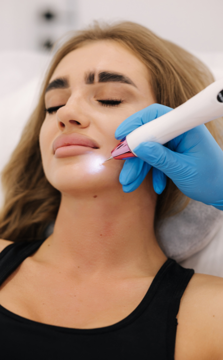 Non-surgical plasma pen treatment at candibrows improving fine lines and wrinkles